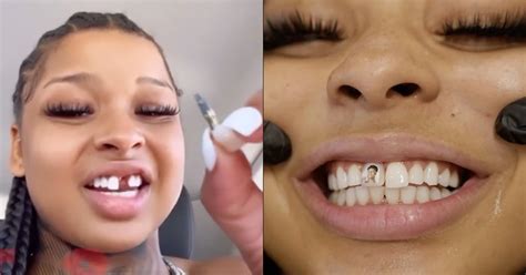 blueface girlfriend with missing tooth|Chrisean Rock Pulls Out New Dental Implant To。